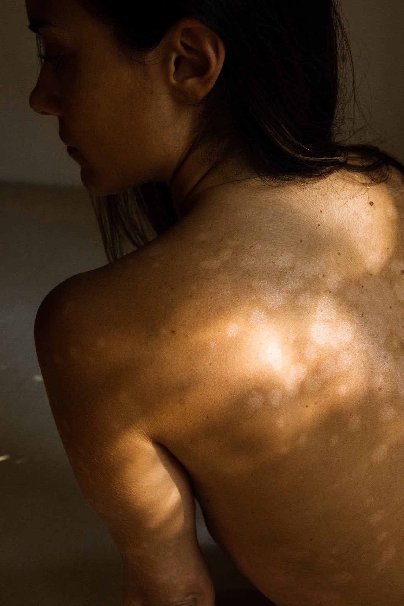 Mujer de espaldas mostrando manchas claras en la piel, en una historia sobre cuidado y aceptación de la piel